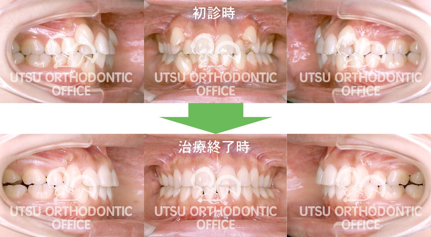 叢生(でこぼこ)の初診時と治療終了後