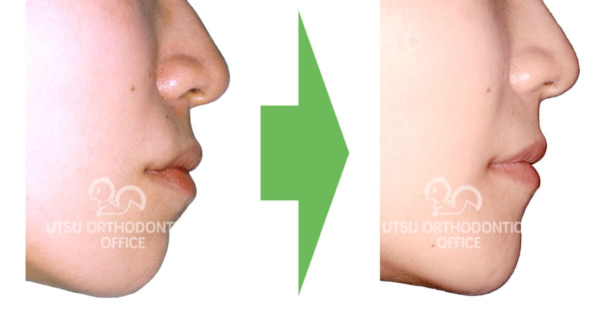 叢生(でこぼこ)の初診時と治療終了後の口元の変化