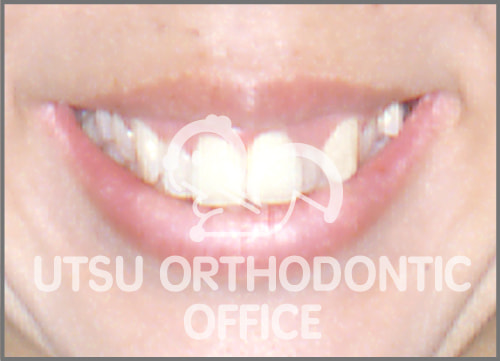 宇津矯正歯科医院症例 ガミースマイル(出歯ぐき)+上顎前突(出っ歯)