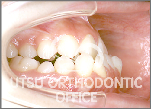 宇津矯正歯科医院症例 外科矯正症例