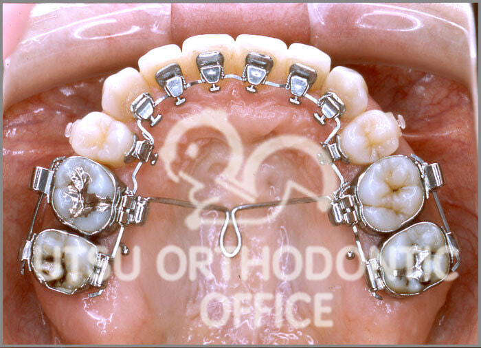 宇津矯正歯科医院症例 舌側矯正治療 (リンガルアプライアンスによる治療)