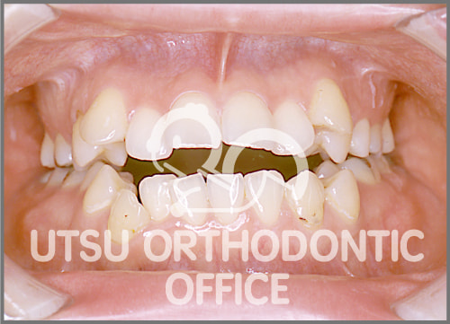 宇津矯正歯科医院症例 開咬(上下の前歯が全く咬んでいない)