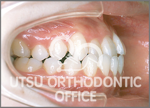 宇津矯正歯科医院症例 反対咬合(受け口)