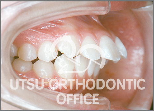 宇津矯正歯科医院症例 上顎前突(出っ歯)