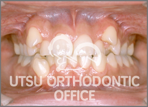 宇津矯正歯科医院症例 叢生(でこぼこ)