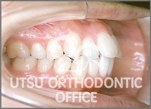 宇津矯正歯科医院症例 歯槽性上下顎前突症 (上下の出っ歯)