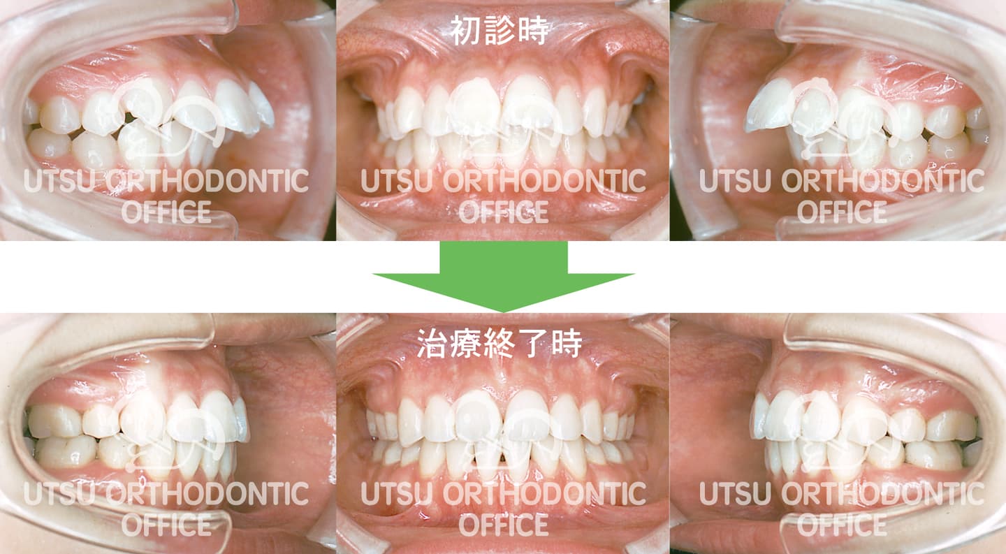上顎前突(出っ歯)の初診時と治療終了後