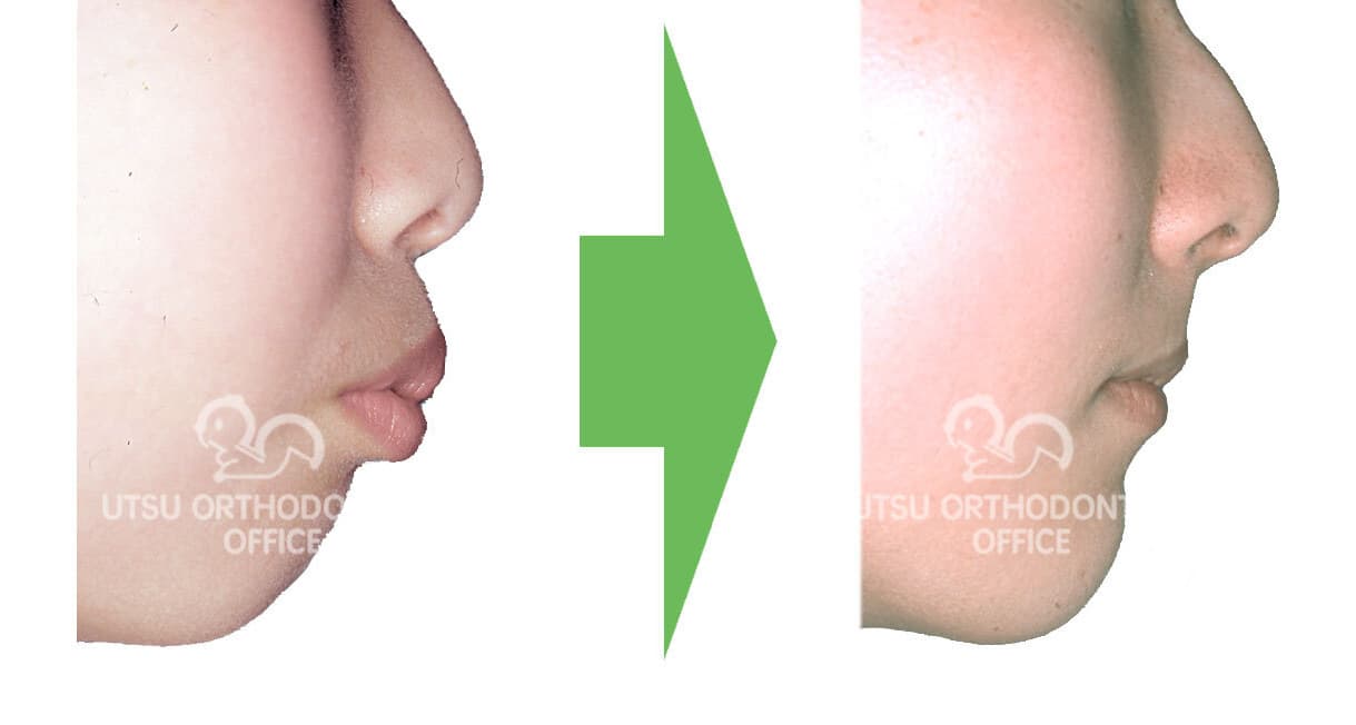 上顎前突(出っ歯)の初診時と治療終了後の口元の変化